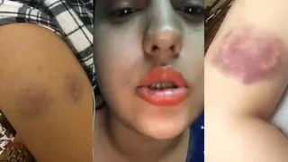 Subuhi Joshi Reveals Images of Injuries Caused by Ex-Fiancee, Siddharth Sagar thumbnail