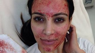 Kim Kardashian Settles Lawsuit Over Vampire Facial