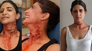 'I Didn’t Know I’ll have a Scar on my Face and I’ll have to Wear Prosthetic for 45 Days': Aahana Kumara Thumbnail