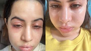 Uorfi Javed clarifies that the swollen face is due to allergies, not filler Thumbnail