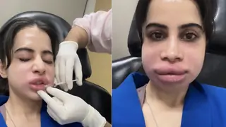 Uorfi Javed dissolves fillers after nine years, sparks conversation around cosmetic choices & beauty pressure Thumbnail