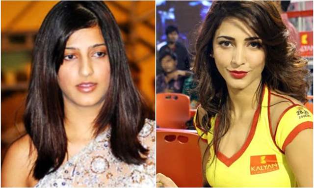 Shruti Haasan on lip fillers