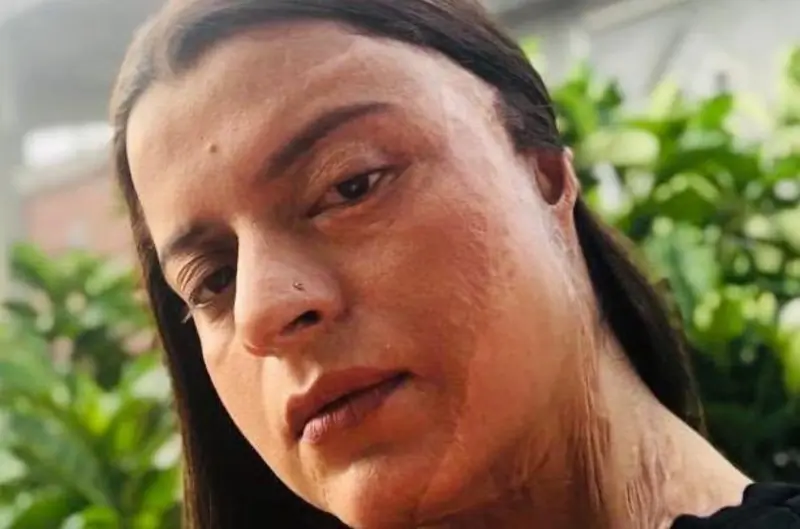 rangoli chandel acid attack