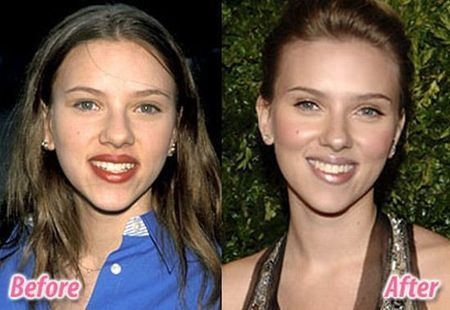 Scarlett Johansson before and after nose job.jpeg